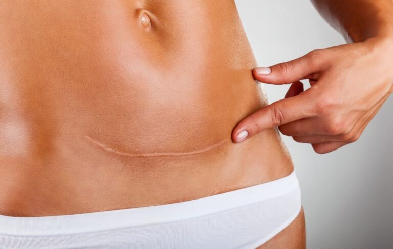 ventre d'une femme présentant une cicatrice
