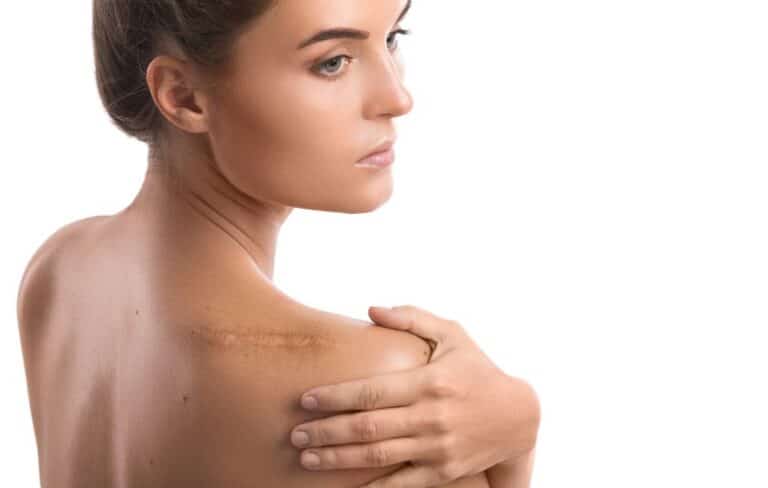 femme présentant une cicatrice dans le haut du dos