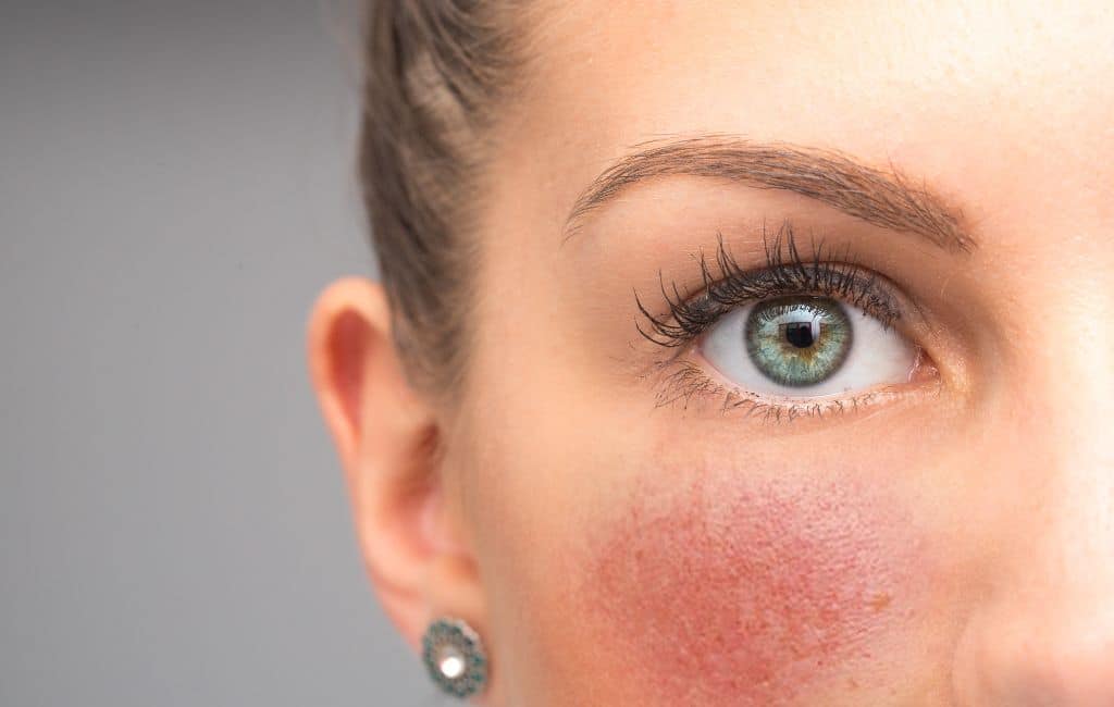 traiter les rougeurs sur le visage grâce au laser vasculaire en Martinique