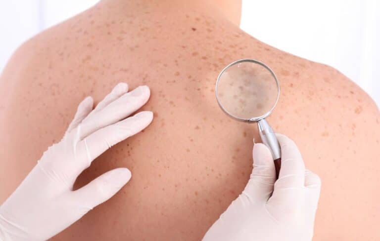 traiter les kératoses et les cancers superficiels de la peau par phytothérapie (LED) au Centre Médical Agora Martinique