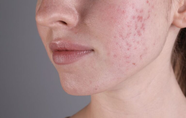 femme présentant des cicatrices d'acné sur le visage