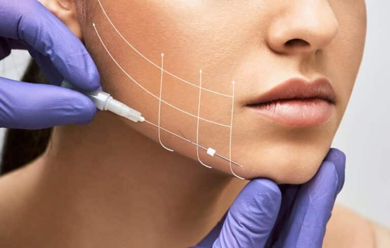 pose de fils tenseurs sur le visage d'une femme